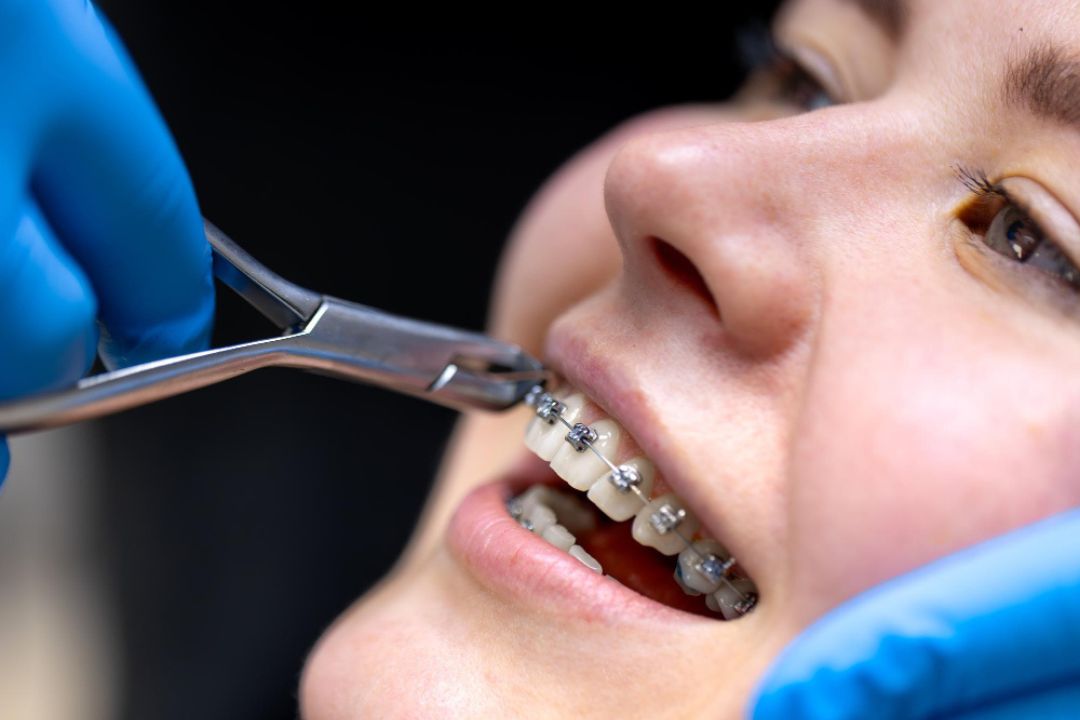 step-by-step dental braces treatment process